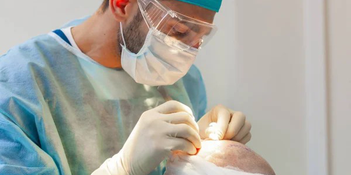 After a hair transplant, how long do grafts remain secure?