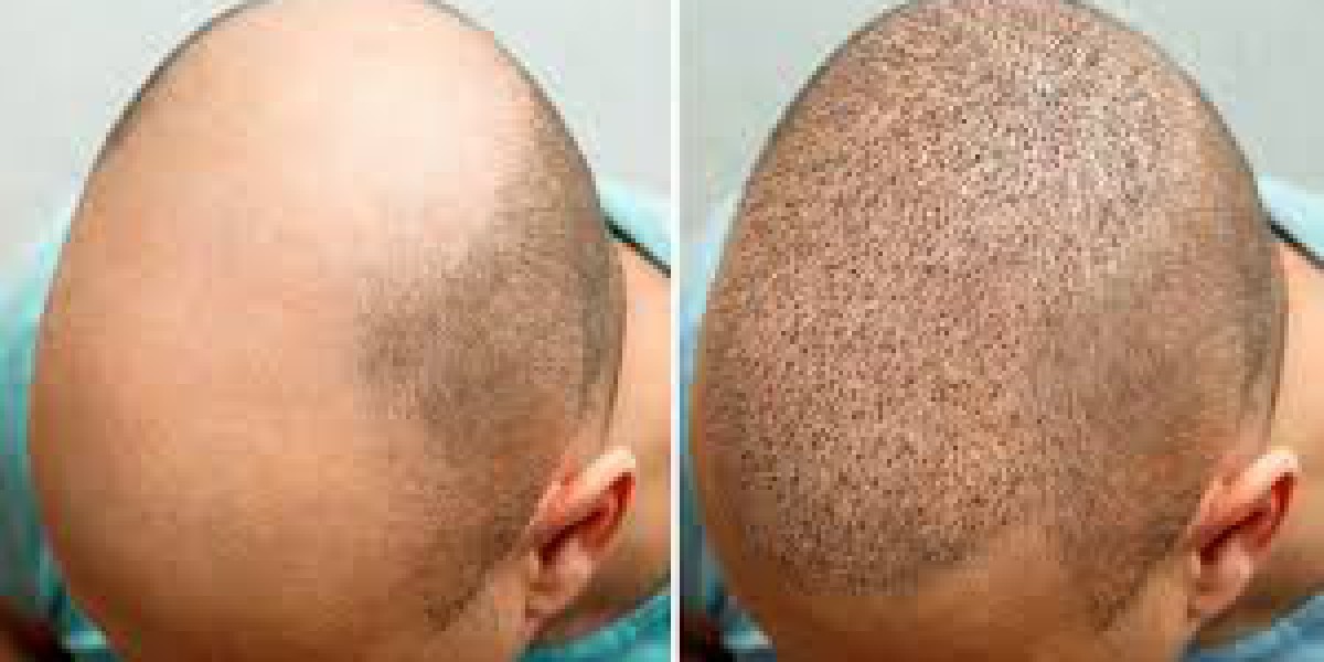 There are five popular and advanced hair loss treatments available in Dubai