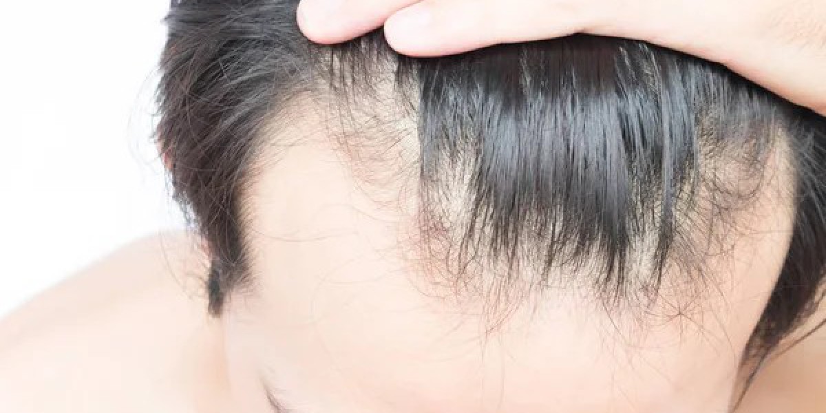 Which vitamin deficiency causes hair loss?