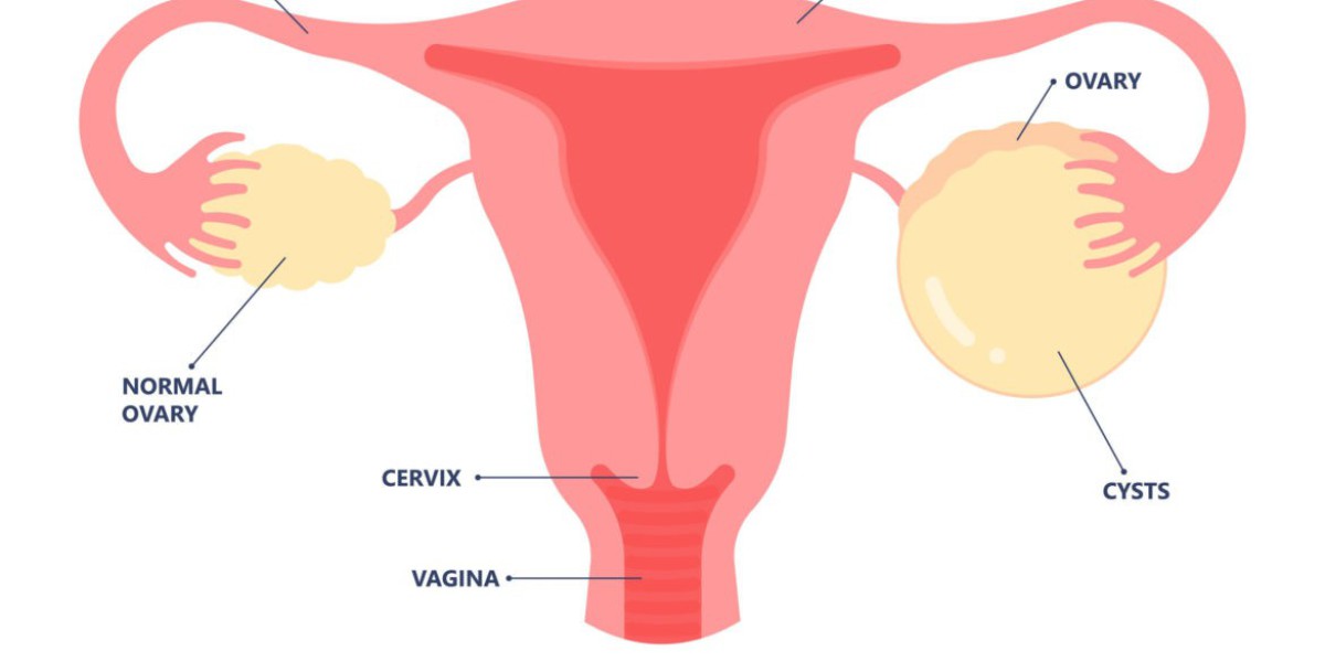 Understanding Ovarian Cysts Treatment in Jaipur