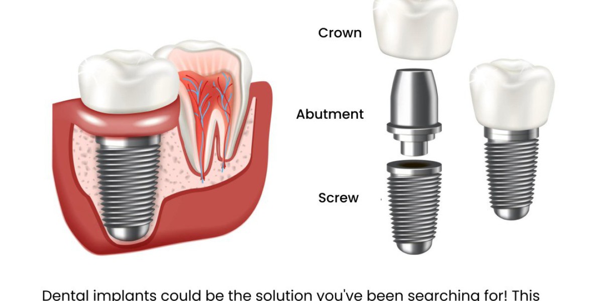 Best Dental Implants in Bangalore: A Guide to Restoring Your Smile