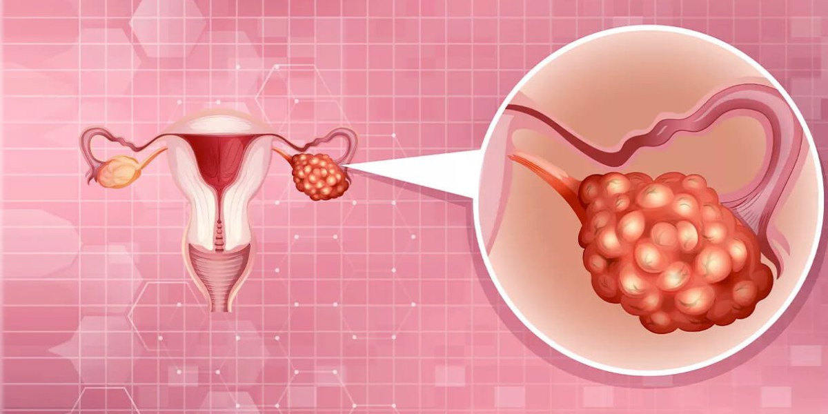 Bayer AG's Natural Solutions for Ovarian Cysts: Market Expansion and Patient Care