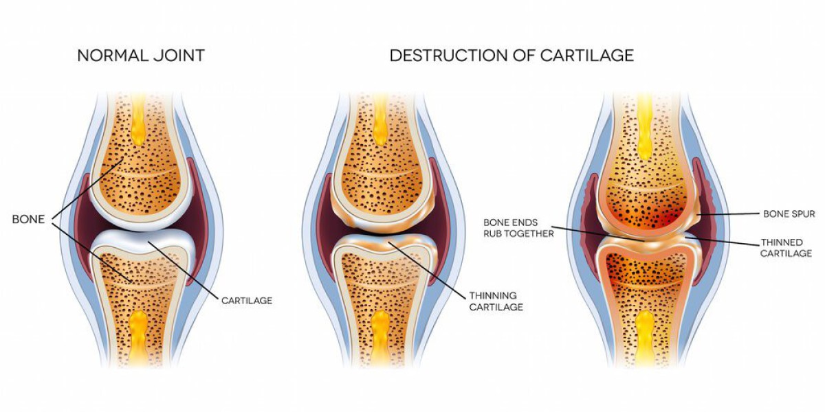 Cartilage Repair Market Global Latest Trends and Insights 2024 to 2031