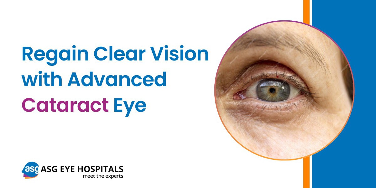 Everything You Need to Know About Cataract Eye Surgery