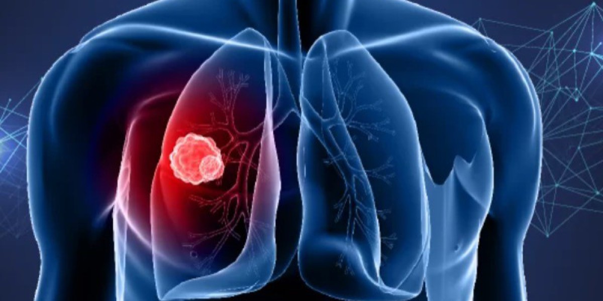 Understanding Lung Cancer: Causes, Symptoms, and Treatment