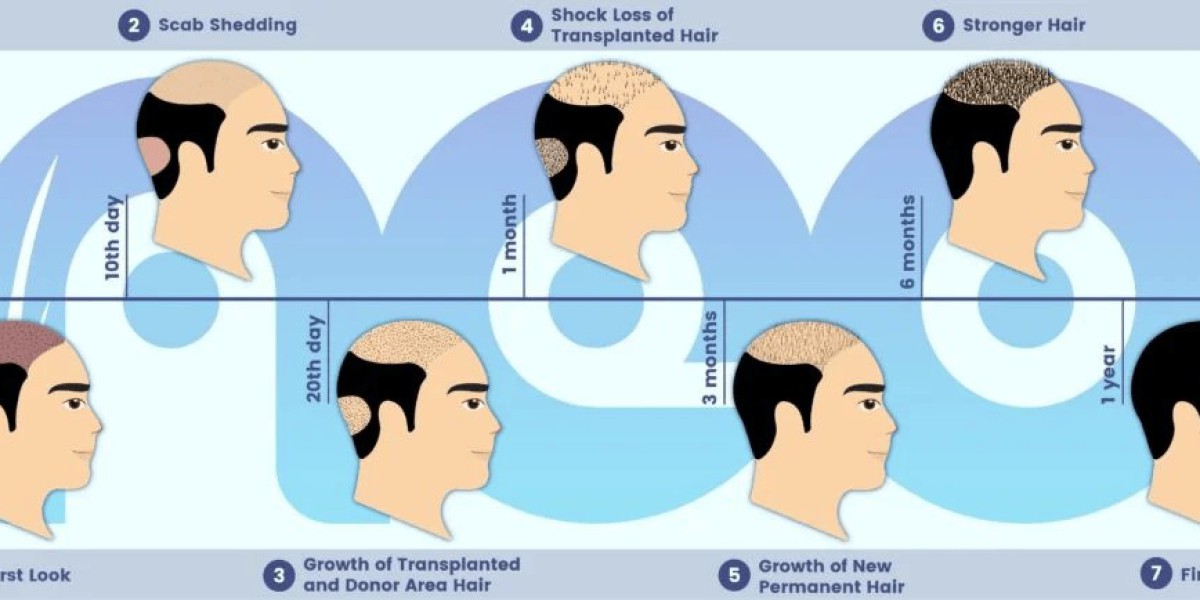 Why Turkey is the Leading Destination for Affordable and Effective Hair Replacement Surgery