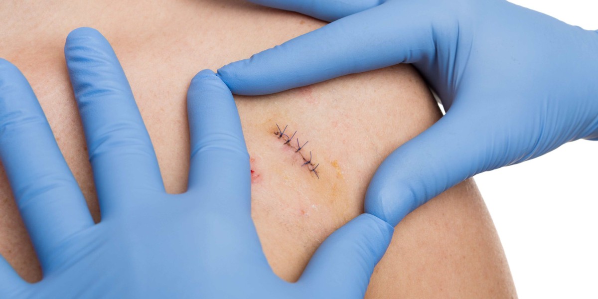 How to Take Care of Stitches: Essential Tips for Quick Healing