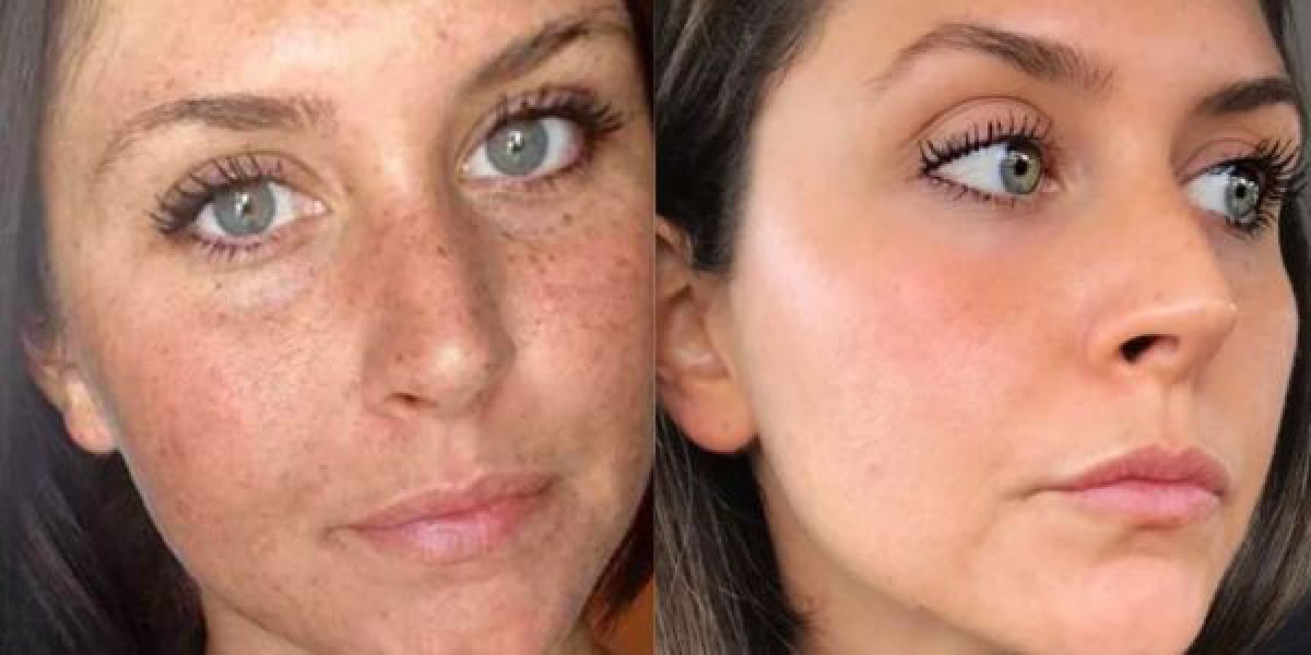 How Long Does It Take for an Anti-Pigmentation Treatment Kit to Show Results?